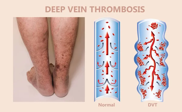 Механизм синдрома эконом-класса, тромбоз глубоких вен или ДВТ, эмболия легких, коронарный тромбоз, диаграмма — стоковое фото