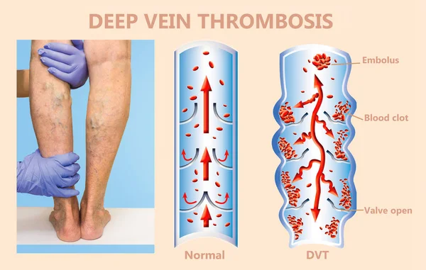 Thrombose veineuse profonde ou caillots sanguins. Embolus . — Photo