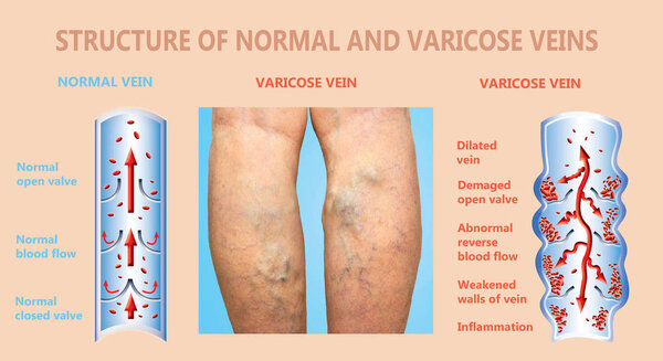 Varicose veins on a female senior legs. The structure of normal and varicose veins.