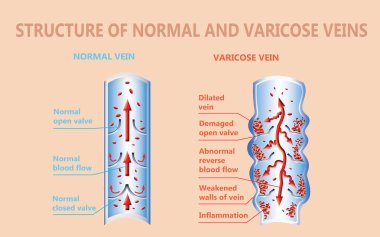 Yaşlı bir kadının bacaklarında varis damarları var. Normal ve varisli damarların yapısı.