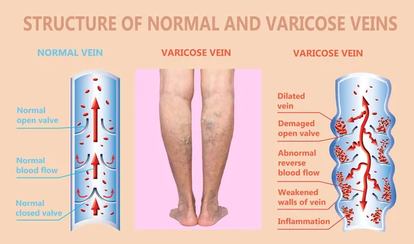 Varices sur les jambes d'une femme âgée. La structure des veines normales et des varices. — Photo