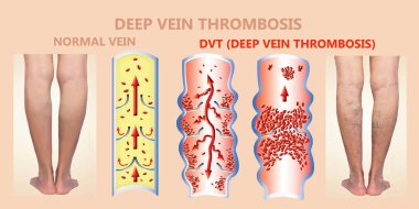 Deep Vein Thrombosis or Blood Clots. Embolus. clipart
