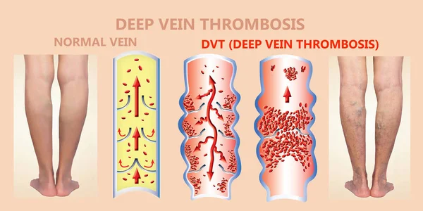 Thrombose veineuse profonde ou caillots sanguins. Embolus . — Photo