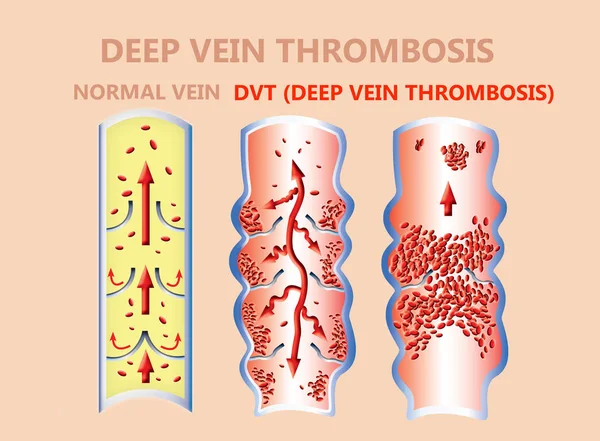 Thrombose. Du flux sanguin normal à la formation de caillots sanguins — Photo