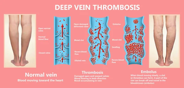 Thrombose. Du flux sanguin normal à la formation de caillots sanguins — Photo