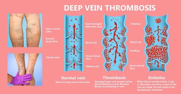 Thrombose veineuse profonde ou caillots sanguins. Embolus . — Photo