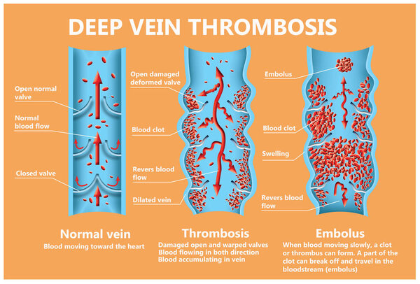 тромбоз. От нормального кровотока к образованию тромба
