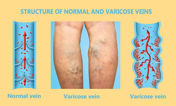 Varices sur les jambes d'une femme âgée. La structure des veines normales et des varices. — Photo