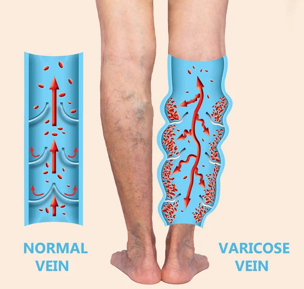 Vene varicose su gambe più anziane femminili. La struttura delle vene normali e varicose. — Foto Stock