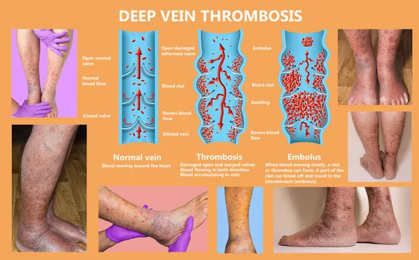 Mécanisme du syndrome de classe économique, thrombose veineuse profonde ou TVP, embolie pulmonaire, thrombose coronaire, diagramme — Photo