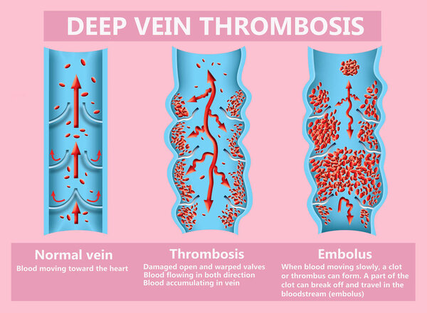 тромбоз. От нормального кровотока к образованию тромба
