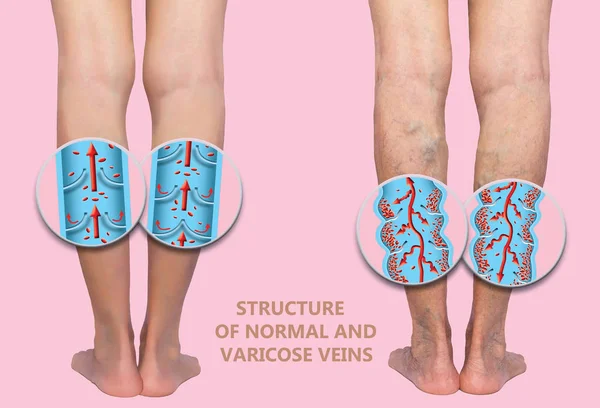 Venas varicosas en las piernas de una mujer mayor. La estructura de las venas normales y varicosas. — Foto de Stock