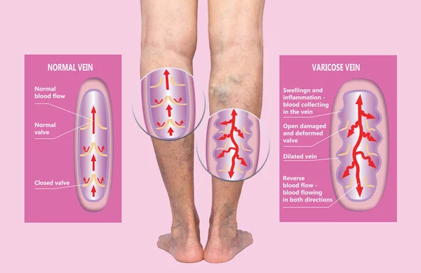 Varicose veins on a female senior legs. The structure of normal and varicose veins.