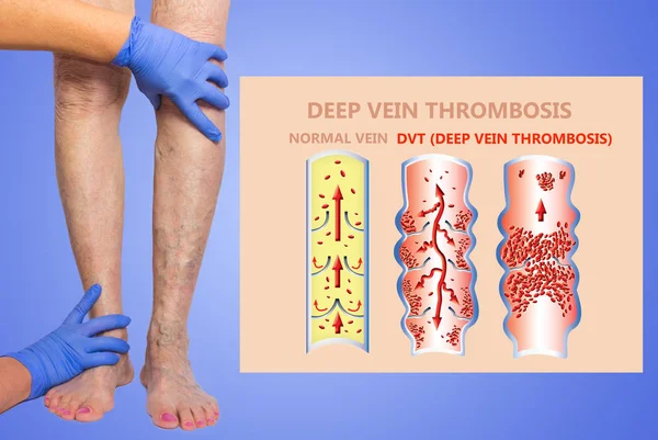 Trombosis venosa profunda o coágulos de sangre. Embolo . — Foto de Stock