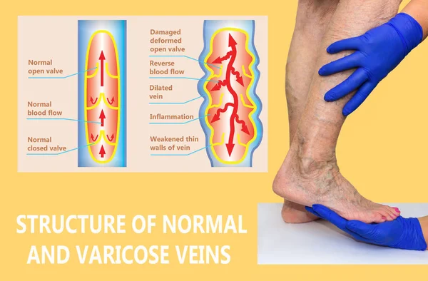 Yaşlı bir kadının bacaklarında varis damarları var. Normal ve varisli damarların yapısı. — Stok fotoğraf