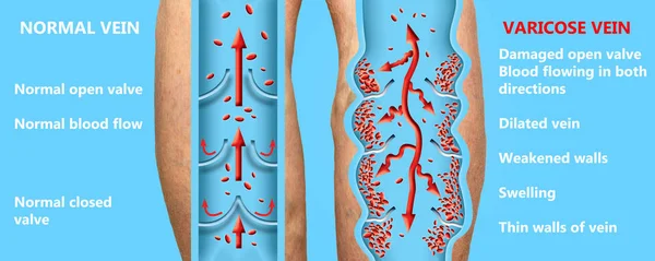 여자의 윗 다리에 정맥 이 있어. 정맥류와 정맥류 정맥의 구조. — 스톡 사진
