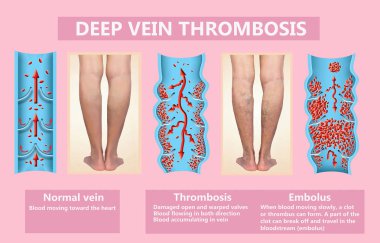 Derin ven trombozu veya kan pıhtılaşması. Emboli.