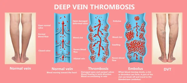 Thrombose veineuse profonde ou caillots sanguins. Embolus . — Photo