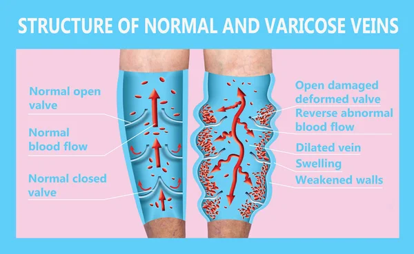 Varicose veins on a female senior legs. The structure of normal and varicose veins.