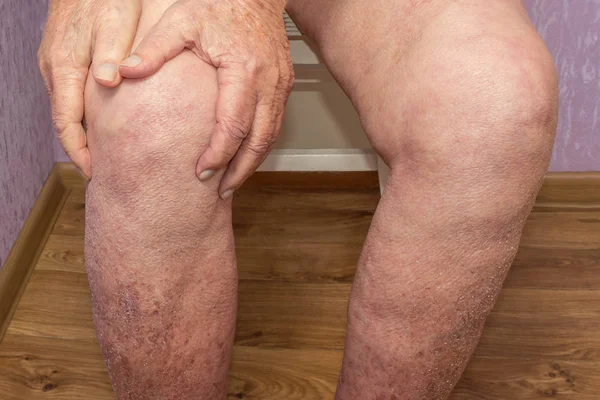 Hombre mayor sosteniendo la rodilla con dolor. Collage. Concepto de dolor abstracto y desesperación . — Foto de Stock