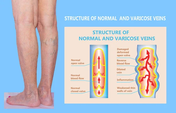 Varicose veins on a female senior legs. The structure of normal and varicose veins.