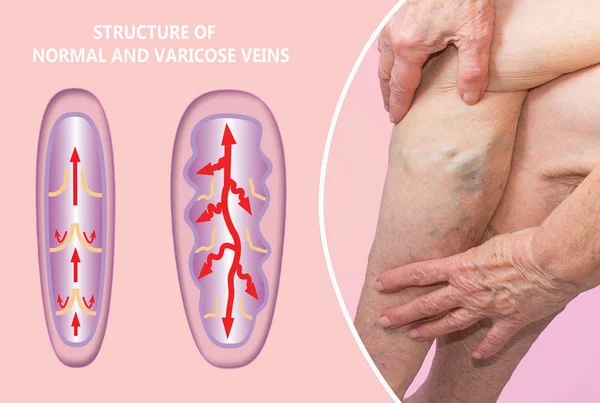 Venas varicosas en las piernas de una mujer mayor. La estructura de las venas normales y varicosas. — Foto de Stock