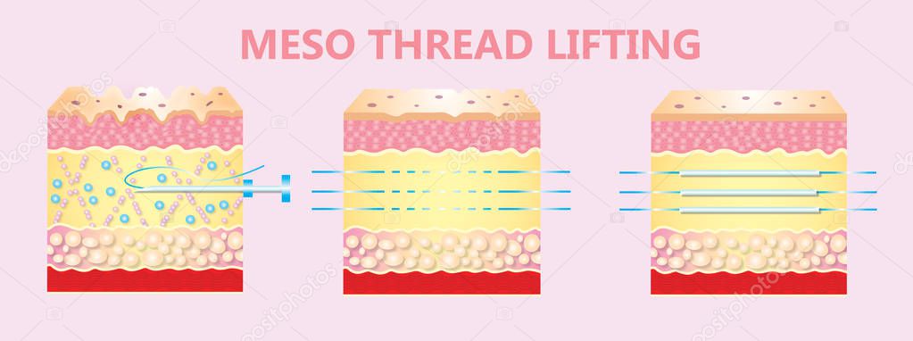 illustration of meso threads lifting
