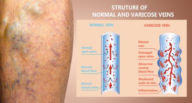 Varicose veins on a female senior legs. The structure of normal and varicose veins. clipart