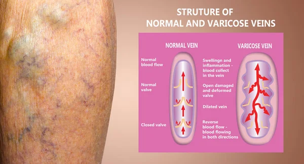 Yaşlı bir kadının bacaklarında varis damarları var. Normal ve varisli damarların yapısı. — Stok fotoğraf