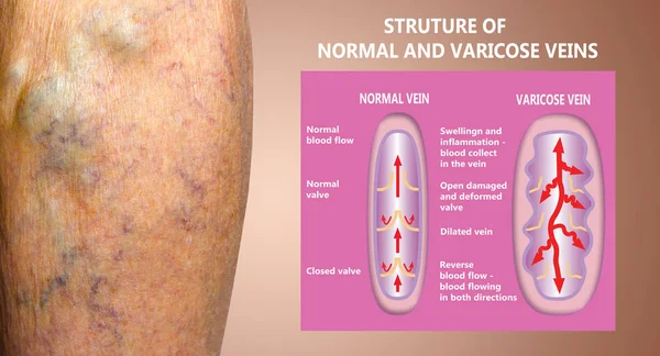 Varicose veins on a female senior legs. The structure of normal and varicose veins.