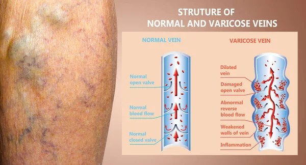 Varices sur les jambes d'une femme âgée. La structure des veines normales et des varices. — Photo