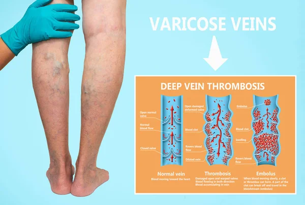 Thrombosis. From Normal blood flow to Blood clot formation — Stock Photo, Image
