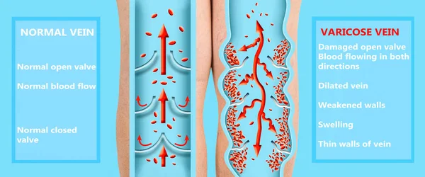 Varicose veins on a female senior legs. The structure of normal and varicose veins.