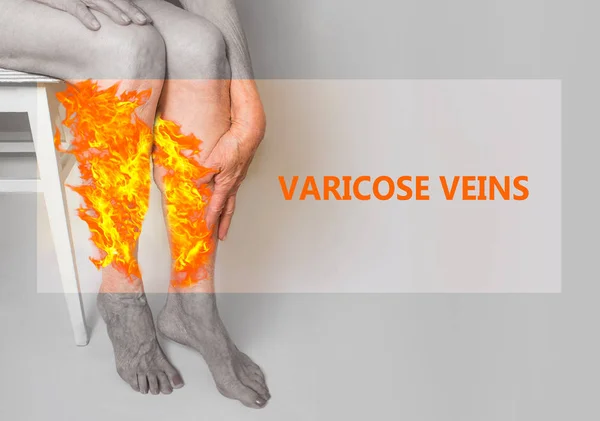 Varicose veins on a legs of old woman on pastel.