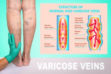 Yaşlı bir kadının bacaklarında varis damarları var. Normal ve varisli damarların yapısı.