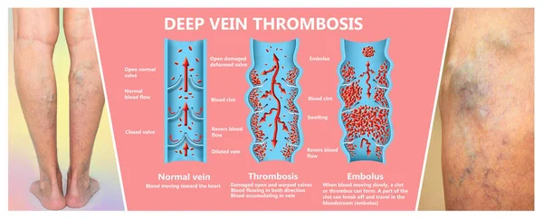 Trombose de Veia Profunda ou Fendas de Sangue. Embolus . — Fotografia de Stock