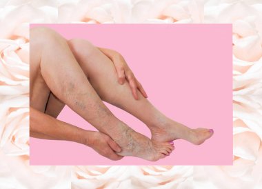 Yaşlı kadın bir ayak üzerinde varisli damarlar