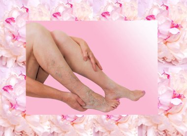 Yaşlı kadın bir ayak üzerinde varisli damarlar