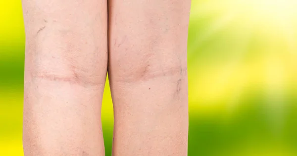 Les varices sur les jambes d'une femme — Photo