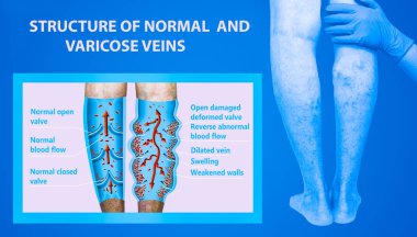 Yaşlı bir kadının bacaklarında varis damarları var. Normal ve varisli damarların yapısı.