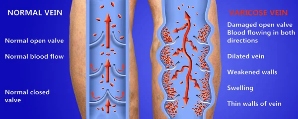 Varicose veins on a female senior legs. The structure of normal and varicose veins.