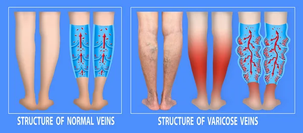 Yaşlı bir kadının bacaklarında varis damarları var. Normal ve varisli damarların yapısı. — Stok fotoğraf