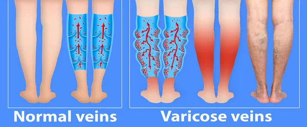 Veias varicosas em umas pernas seniores femininas. A estrutura das veias normais e varicosas. — Fotografia de Stock