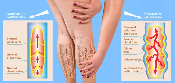 The varicose veins on a legs of woman