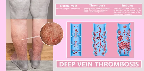 Hyperpigmented Lower limb secondary to venous insufficiency. — Stock Photo, Image