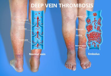 Varisli damarlar ile cilt Close-Up