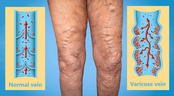 Varicose veins on a female senior legs. The structure of normal and varicose veins.