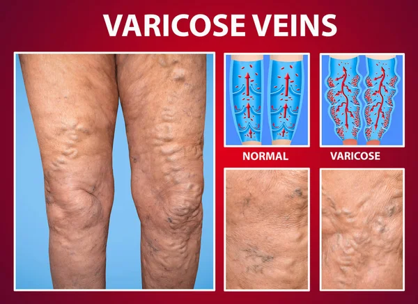 Las venas varicosas en las piernas de la mujer —  Fotos de Stock