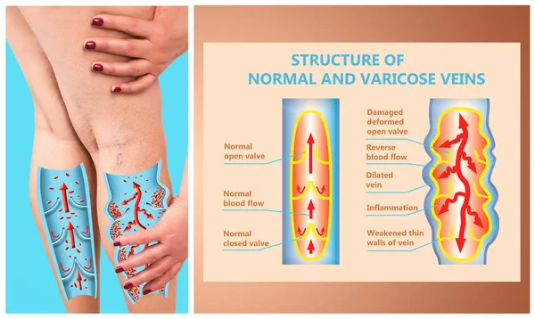 Les varices sur les jambes d'une femme — Photo