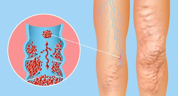 Trombosis venosa profunda o coágulos de sangre. Embolo . — Foto de Stock